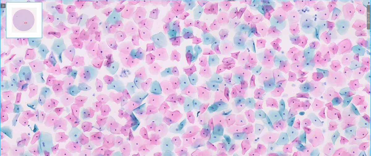 Pap-stained slide preparation result 2